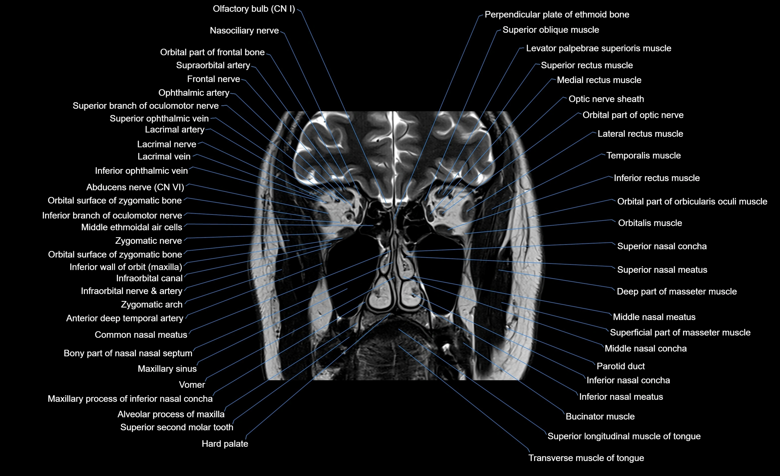 MRI face & paranasal sinuses(PNS) labelled  coronal  cross sectional anatomy 3T radiology  image-img-00001-00024.webp